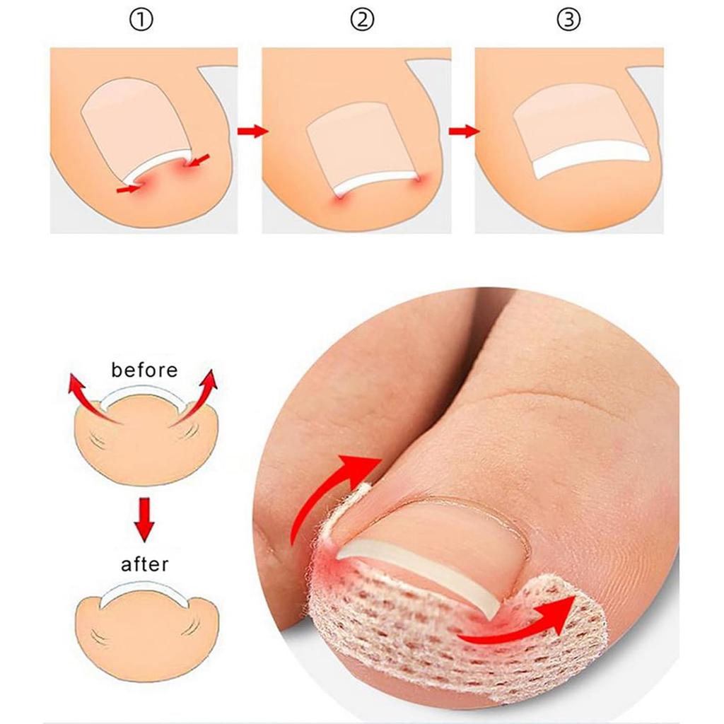 10Pcs Toenail Correction Stickers – Elastic Ingrown Nail Treatment Patch Pedicure Tool