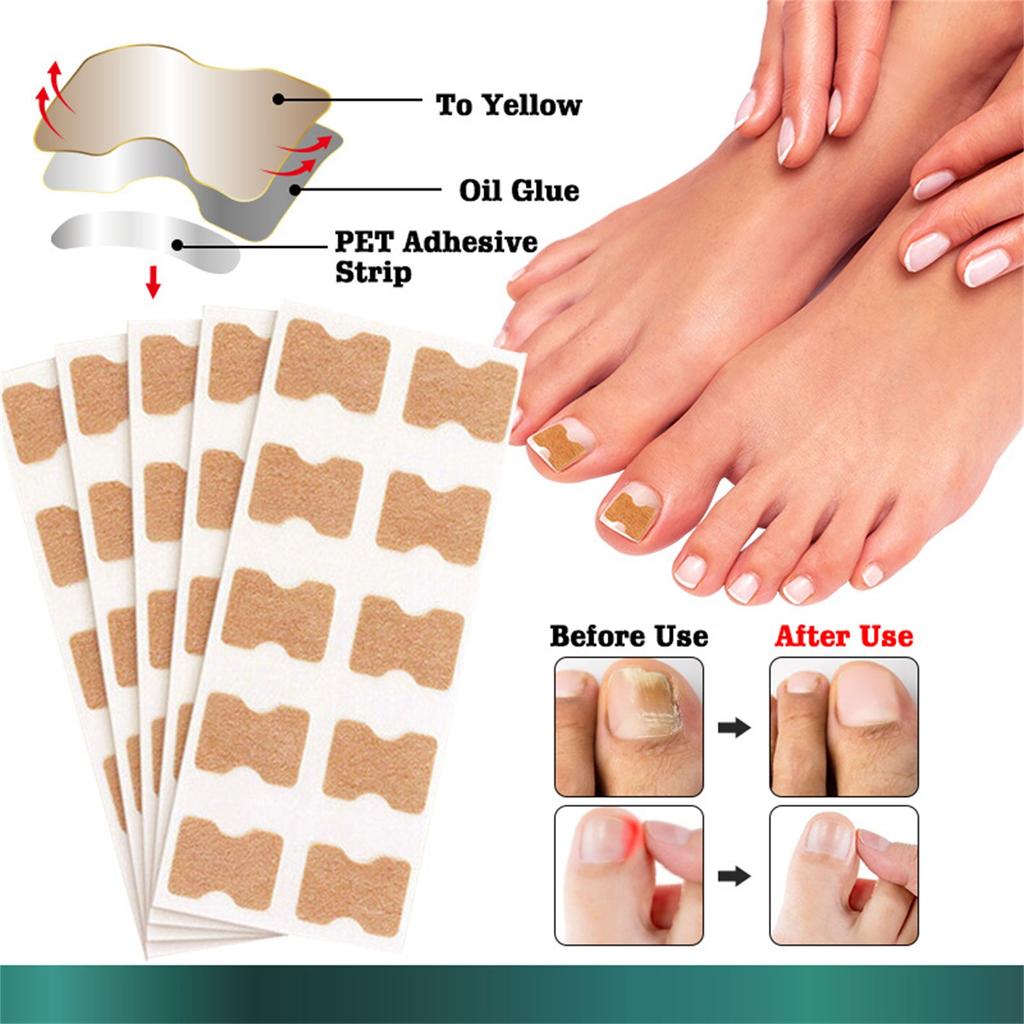 Ingrown Toenail Correction Stickers Hands And Feet Soft Nail Inlaid Nail Thickening Bright Nail Furrow Gray Nail Care Patch 50pcs