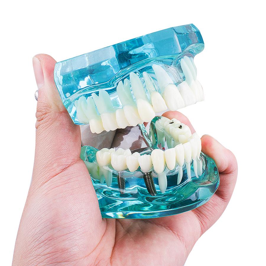 Dental Study Tooth Transparent Adult Pathological Teeth Model