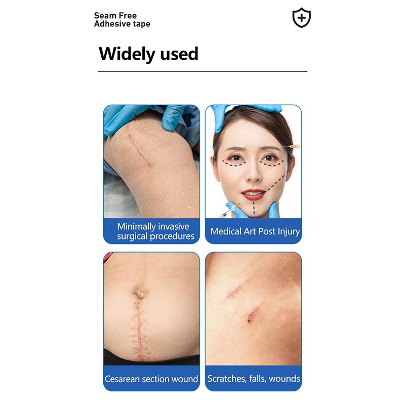 Полоски для закрытия ран Хирургические швы Послеродовое лечение ран Косметическая хирургия Клей Медицинское здравоохранение