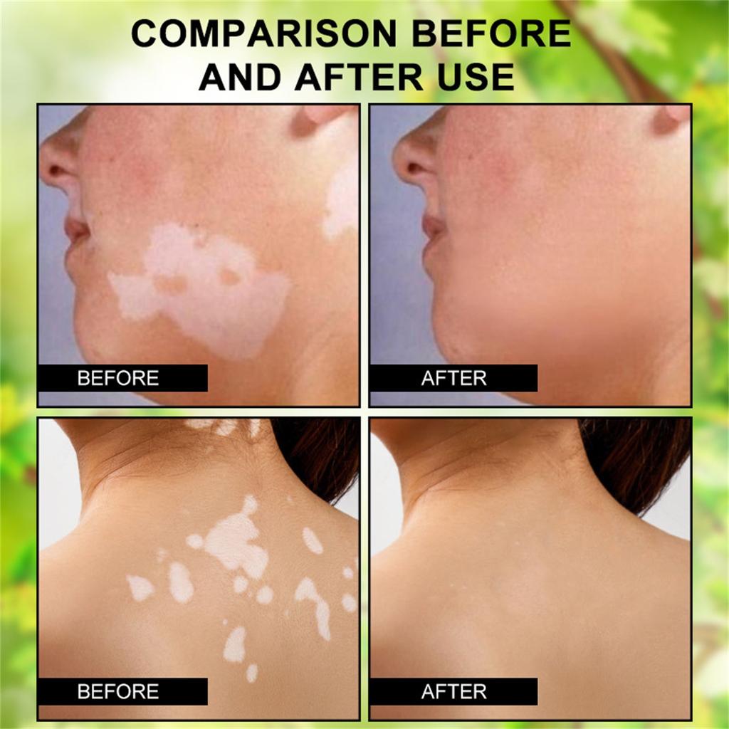 Крем от витилиго, натуральное облегчение витилиго для кожи. Витилиго, крем для ухода за витилиго, уменьшение белых пятен и улучшение пигментации кожи, простота в использовании.