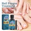 Toenail Fungus Care, FastActing Nail Care Liquid For Fungus Under & Around Restores The Healthy Appearance Of Nails 30ml