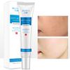 Acne Treatment Cream Moisturizing Control Oil Shrinking Pores Remove Ace Marks Pimple Removal Product