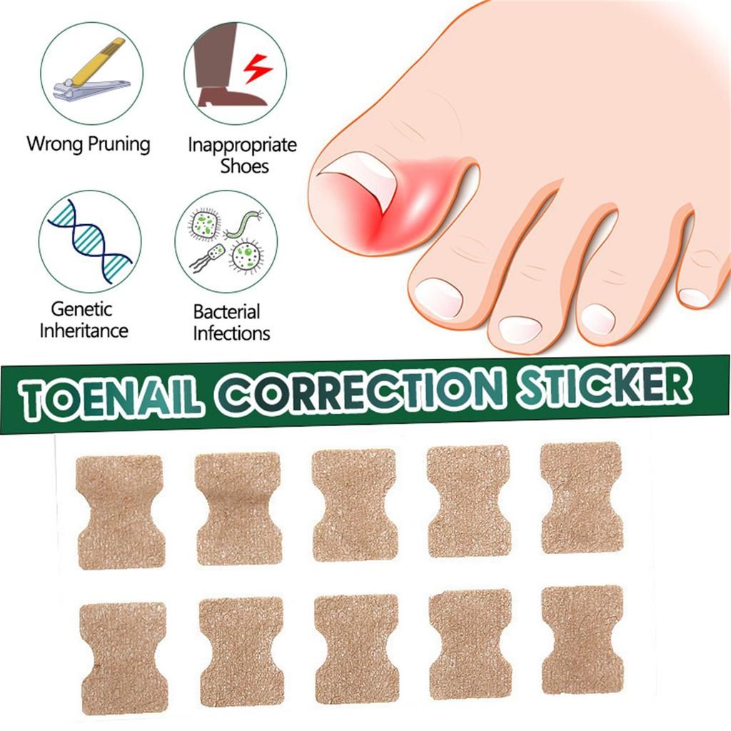 Ingrown Toenail Correction Stickers Hands And Feet Soft Nail Inlaid Nail Thickening Bright Nail Furrow Gray Nail Care Patch 50pcs