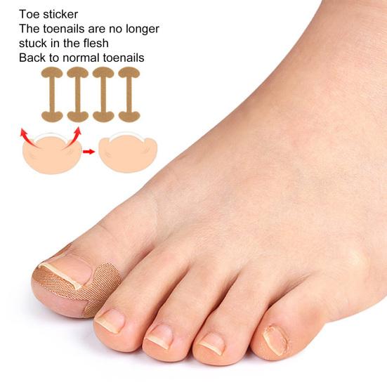 1 комплект, набор для коррекции ногтей на ногах, аксессуары для ухода без клея, премиум-корректор для маникюрного салона