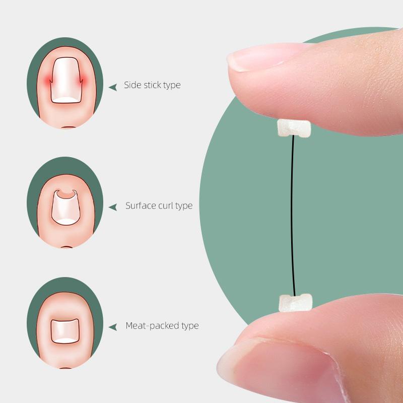 Ingrown Toenail Corrector Tools Pedicure Recover Embed Toe Nail Treatment Professional Ingrown Toenail Correction Foot Care