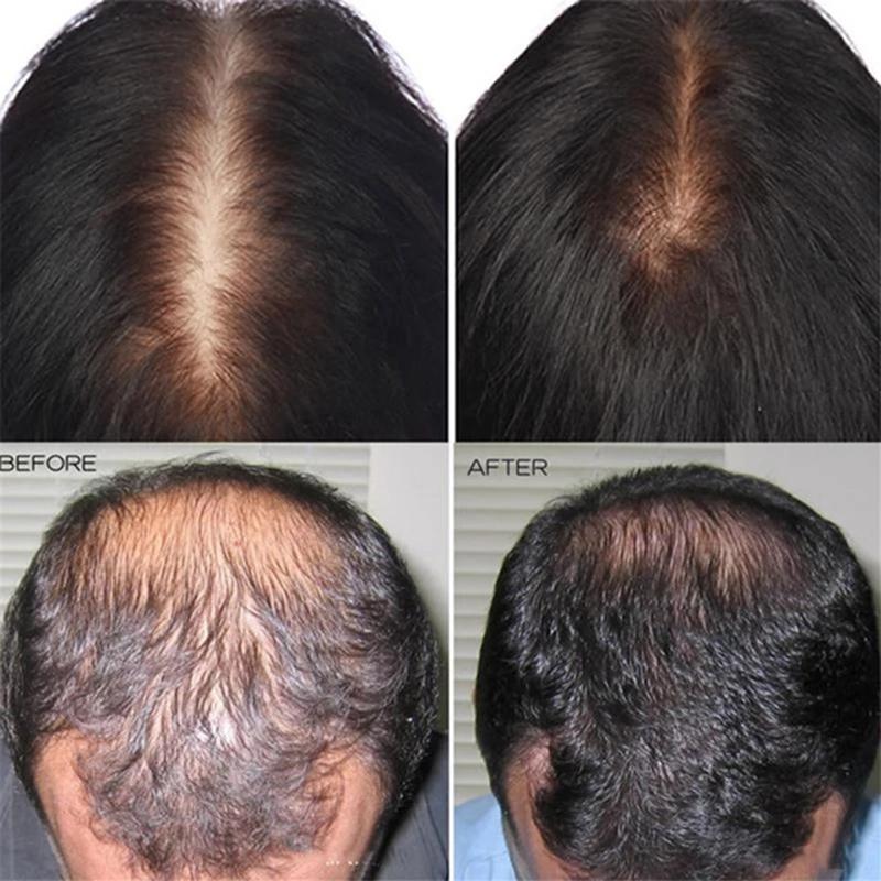 Уход за волосами и кожей головы Уход за волосами и кожей головы Сыворотка-спрей для роста волос Fast Liquid Treatment Уход за кожей головы Волосяной фолликул Естественная красота Здоровье Уход за волосами