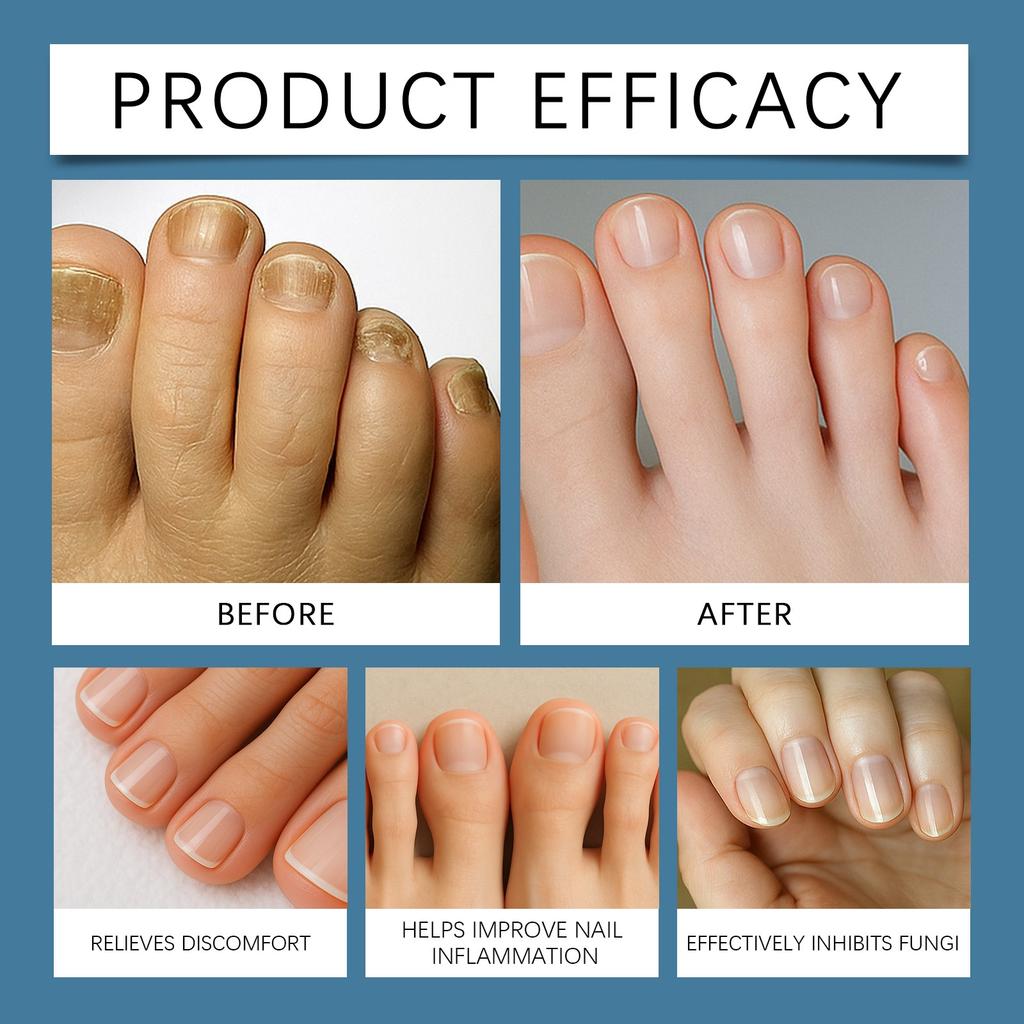 Мазь для ухода при онихомикозе, Крем для укрепления ногтей, Мазь для ногтей для укрепления ногтей и уменьшения расслаивания