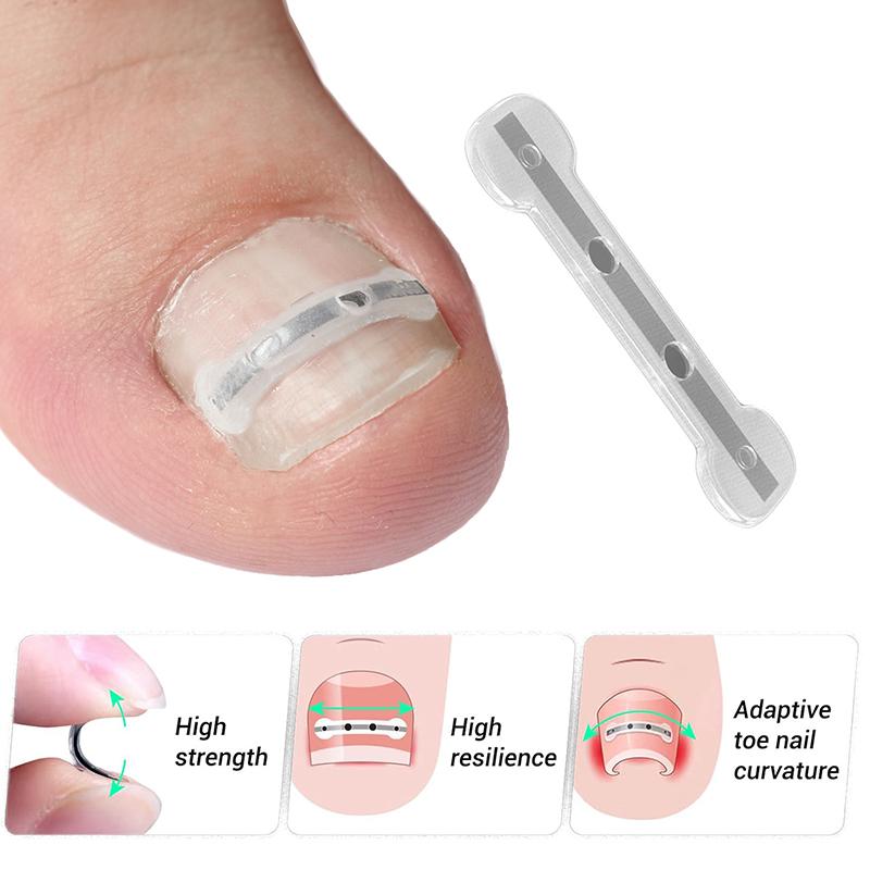 Инструмент для коррекции вросшего ногтя Эластичный пластырь для лечения вросшего ногтя Наклейка для выпрямления Зажим для скоб Инструмент для педикюра