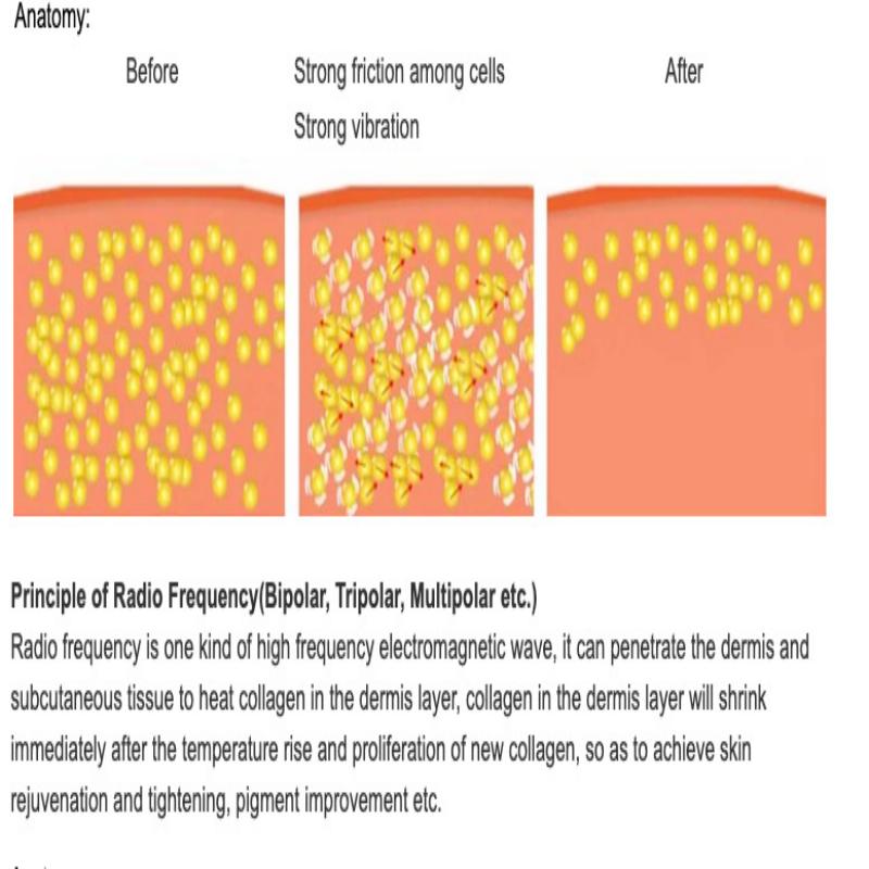 5 In 1 Vacuum Ultrasonic Cavitation Radio Frequency Multipolar RF Body Slimming Machine Skin Lifting Tighten Anti-Wrinkle Device