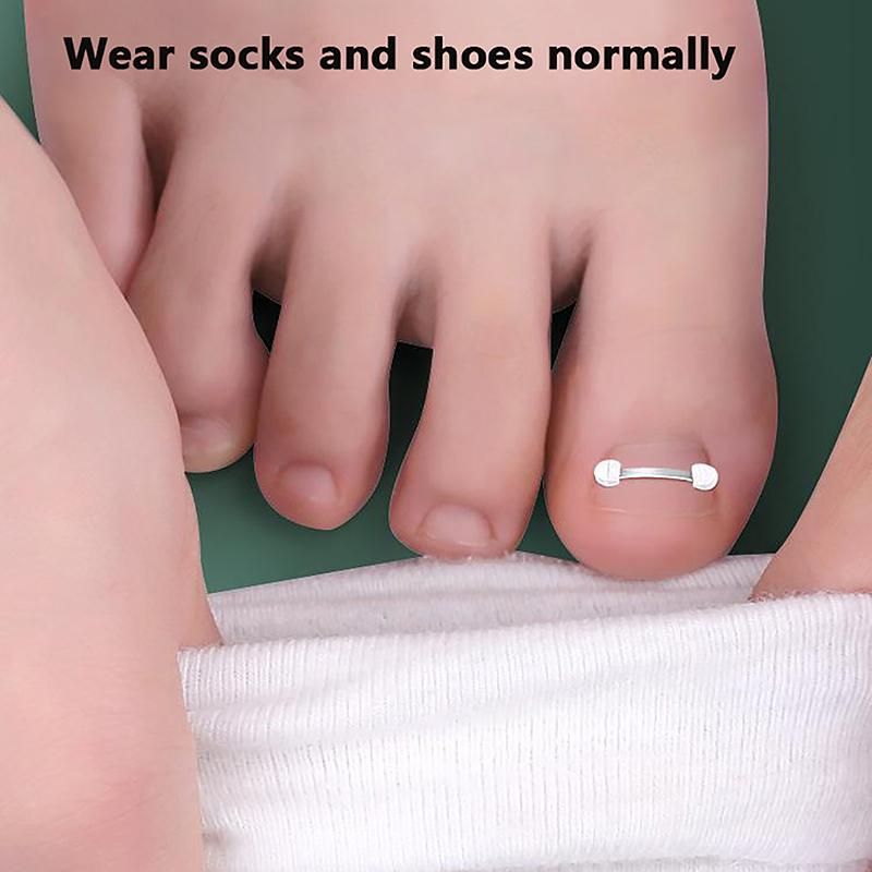 Лечение вросшего ногтя на пальце ноги, эластичная наклейка, выпрямляющий зажим