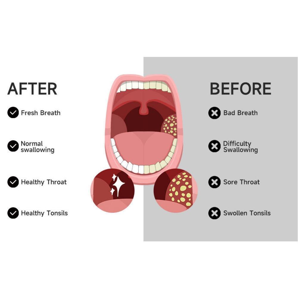 Electric Tonsil Stone Suction Device - Oral Cleaning & Care Tool for Tonsils
