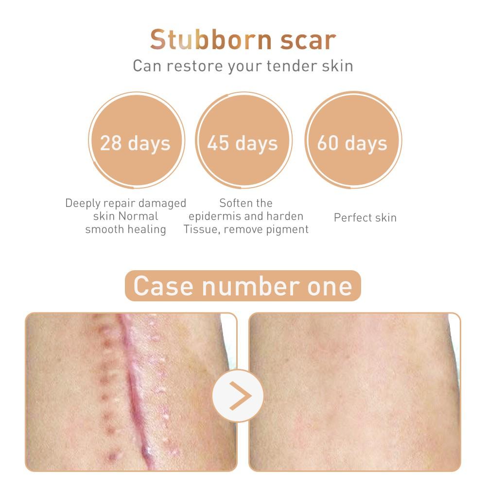 LANBENA Крем для удаления шрамов, акне, растяжек, увлажняющий крем для ухода за кожей, 40 г