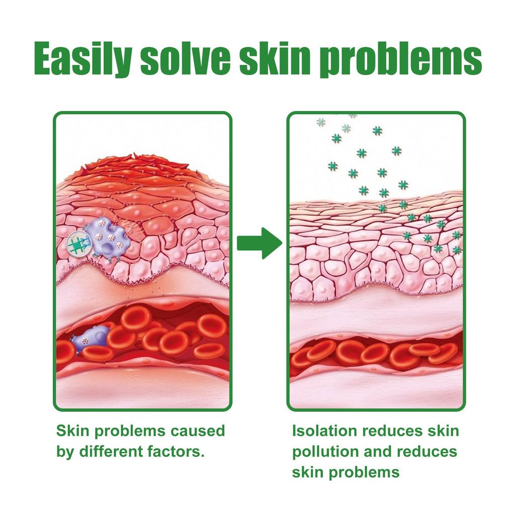 Moisturizing Skin Anainst Itch Cream,Remove Itching, Sweat Blisters, Skin Swelling,