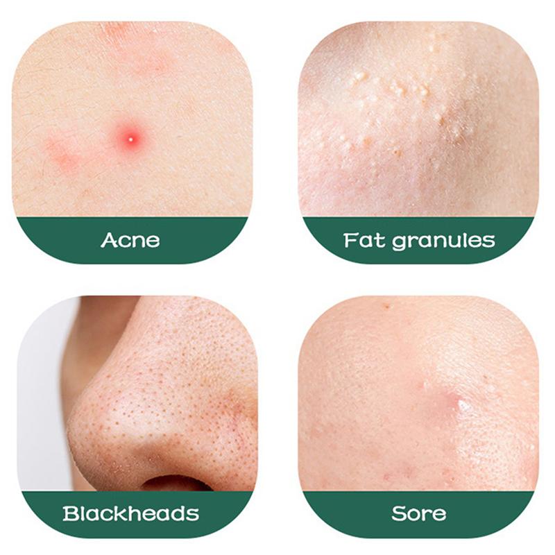 10 шт. Стерильные одноразовые иглы для удаления акне, инструмент для удаления черных точек, индивидуальная упаковка, экстрактор игл для акне для ухода за кожей