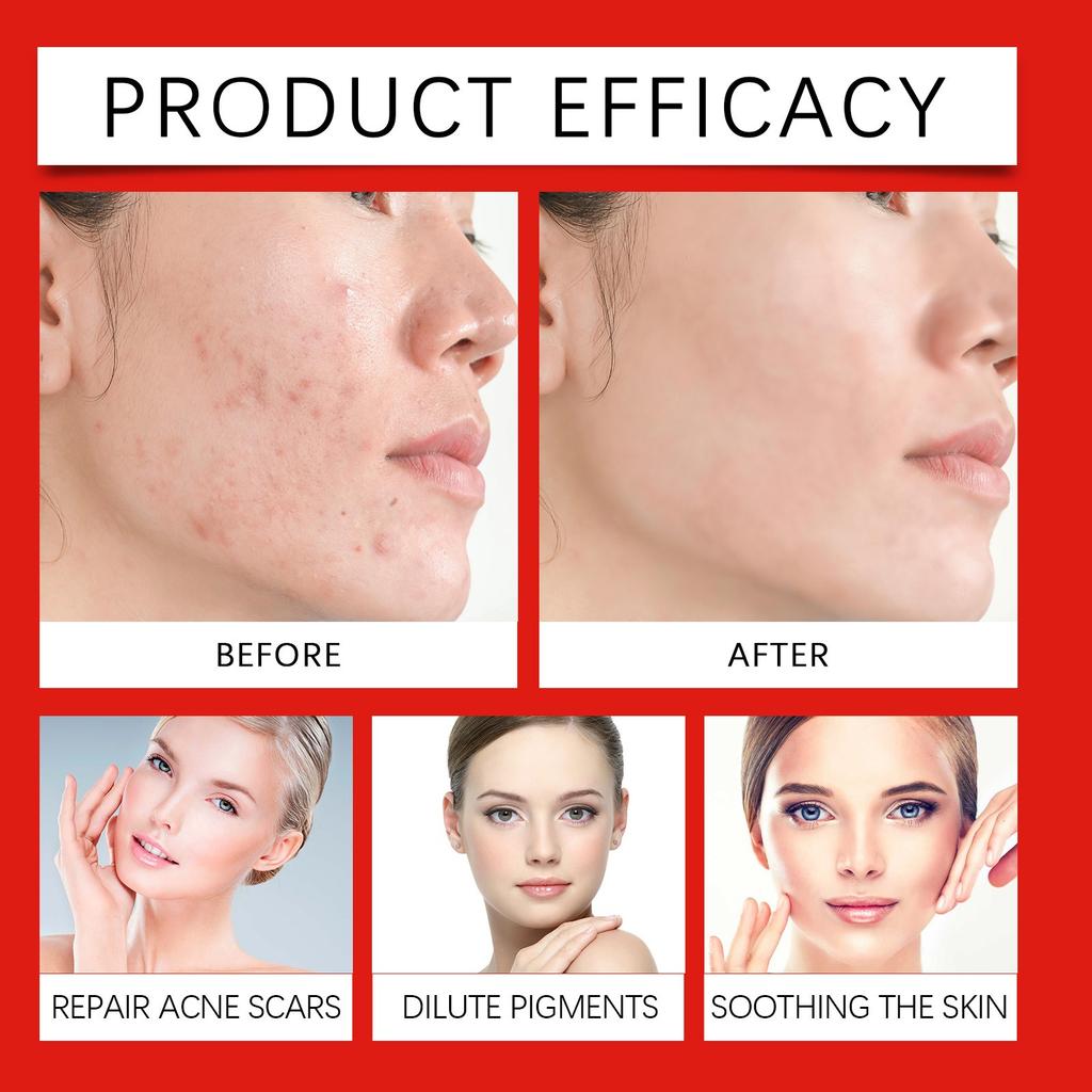 Крем от акне мягко очищает поры, увлажняет и разглаживает кожу.. Увлажняющий ухаживающий крем