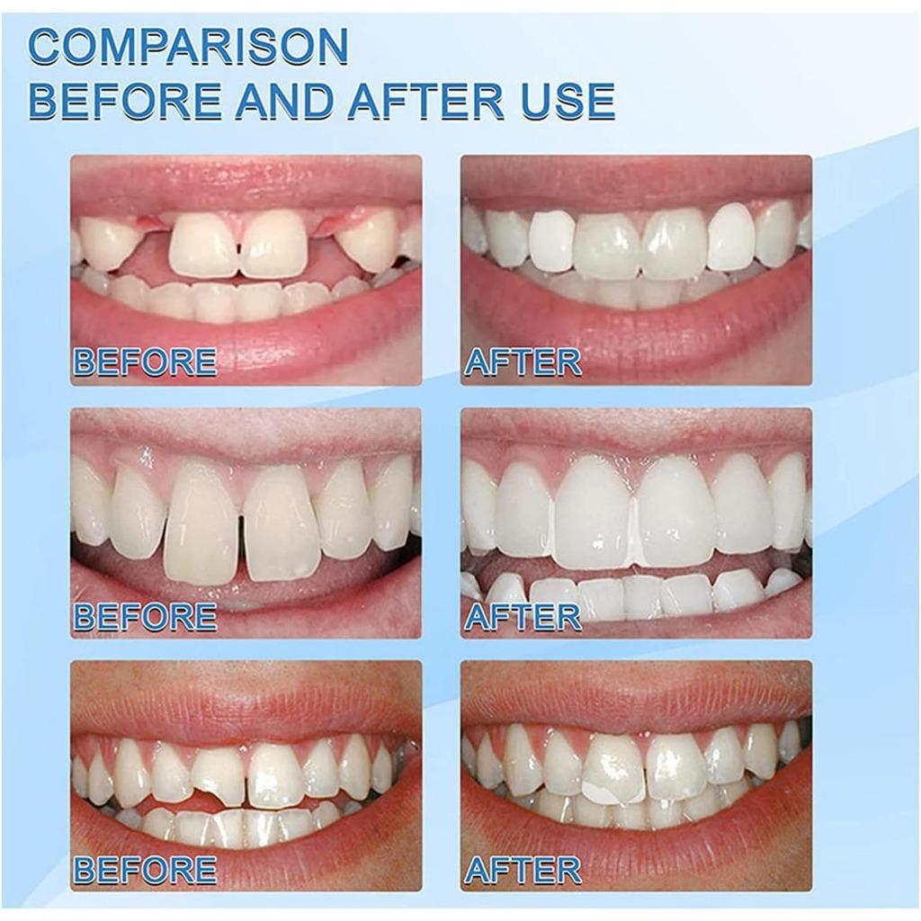 Гранулы для ремонта зубов. Набор для временного ремонта зубов. Многоразовые бусины. (1шт, 30мл)