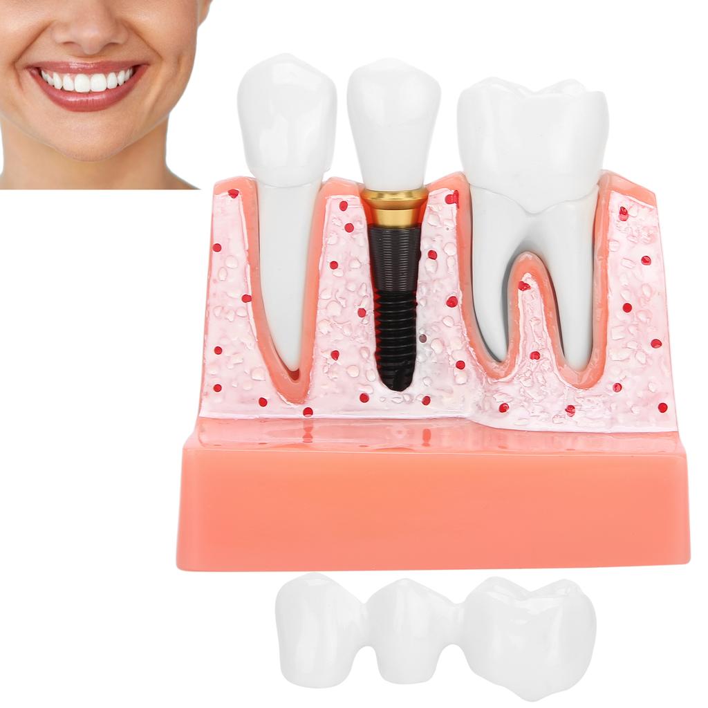 Модель зубов Анализ зубного имплантата Модель короночного моста Демонстрационная модель зуба