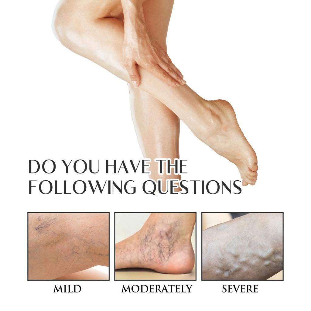 Спрей для варикозного расширения вен, Спрей для варикозного расширения вен, Спрей для варикозного расширения вен 30мл