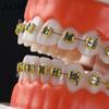 Dental Orthodontic Teeth Model With Metal Braces  School Teaching Equipment