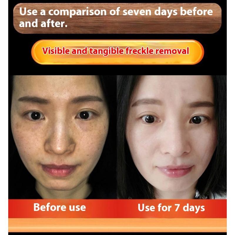 Whitening and Freckle Removing Cream Face Cream Lightening and Removing Spotles Sunburn Brightening Skin Color