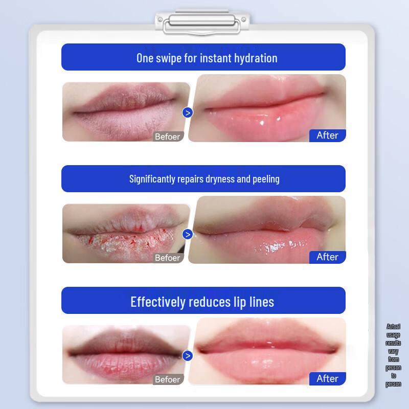 Moisturizing Lip Balm for Dry, Chapped Lips & Cheilitis