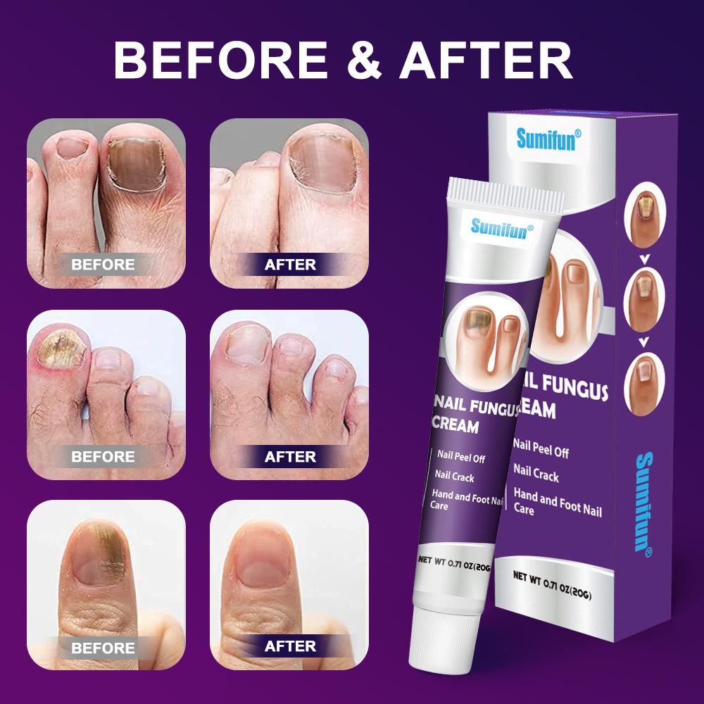 Крем для восстановления онихомикоза, 20 г. Крем для восстановления ногтей для удаления онихомикоза, питания и увлажнения ногтей.