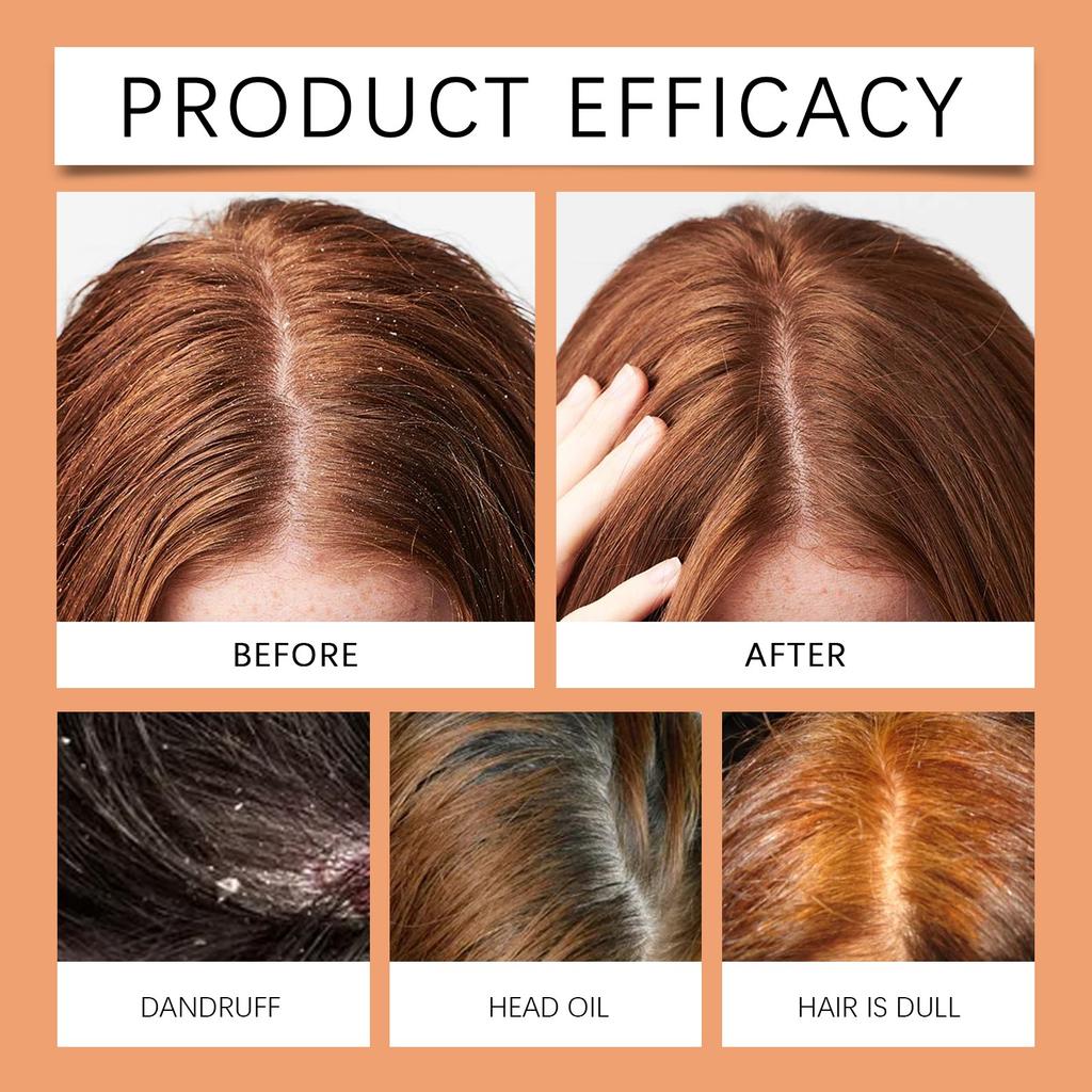 Scalp Scrub , Seed Oil Scalp Exfoliation , Scalp Itching , Remove Dandruff And Promote Hair Growth