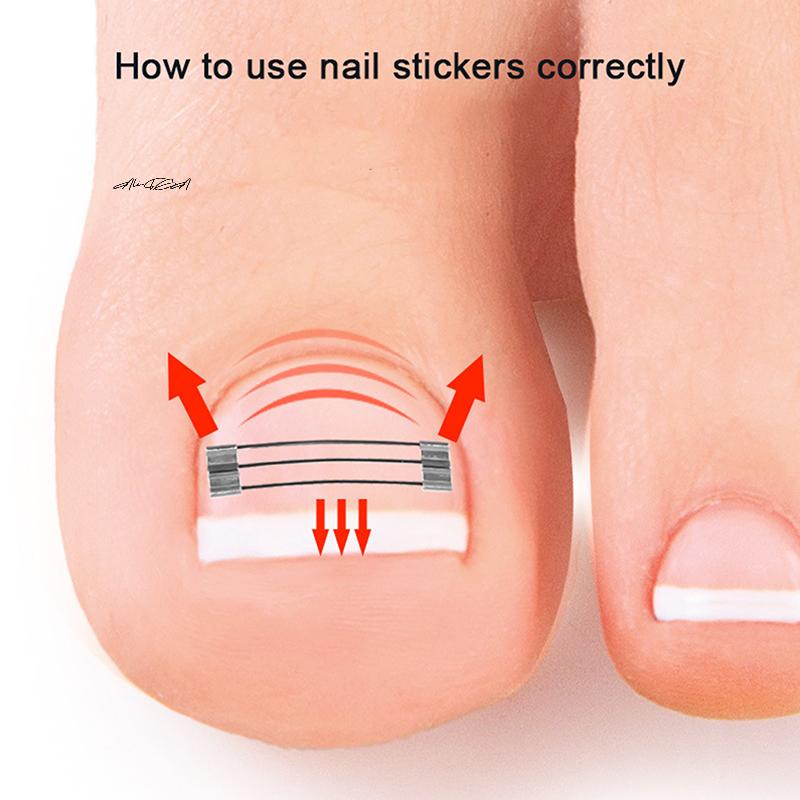 1 комплект Профессиональный корректор для вросшего ногтя, клипса, скоба, педикюрный инструмент для восстановления ногтя на ноге, инструмент для выпрямления вросшего ногтя