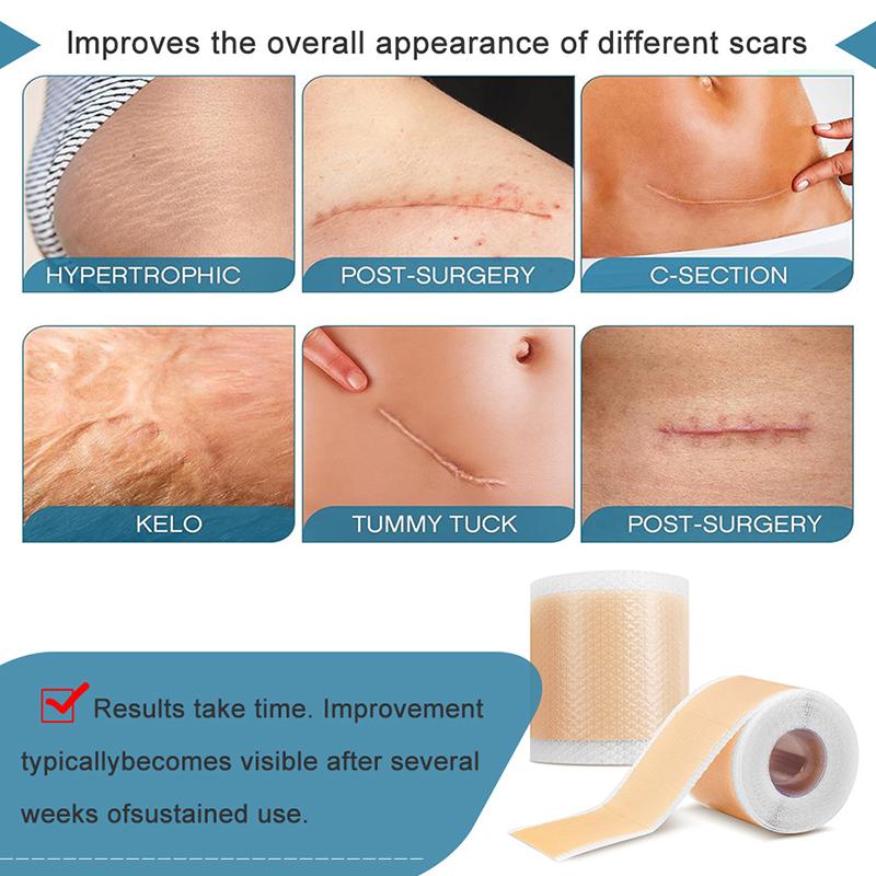 Professional Silicone Scar Sheets Scars Treatment Reusable Silicone Scar Strips Type For Keloid C-Section Surgery Burn