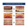 Calculusfree Dissolving Dental Spray, Dental Calculus Remover Teeth Cleaner, Mouth Refreshing Spray