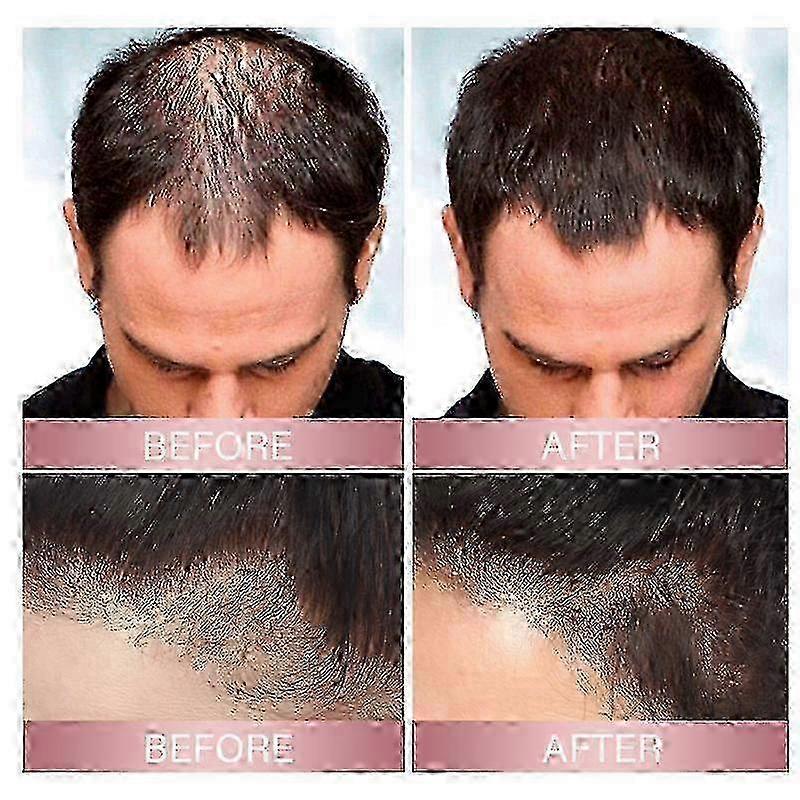 3Pcs Zephta H-Regrow 2.0, Zephta Hair Regrowth, Prorevita Rice Nutri Spray, for Hair