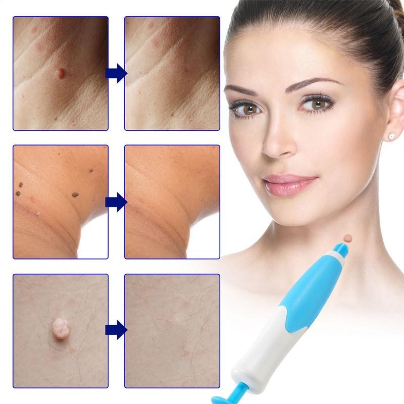 2-in-1 Auto Tags Skin Tags Removal Pen Fast Removal Kit Safe Auto Tags Removal Pen With 40 Rubber Bands For 2-8mm Skin Tags
