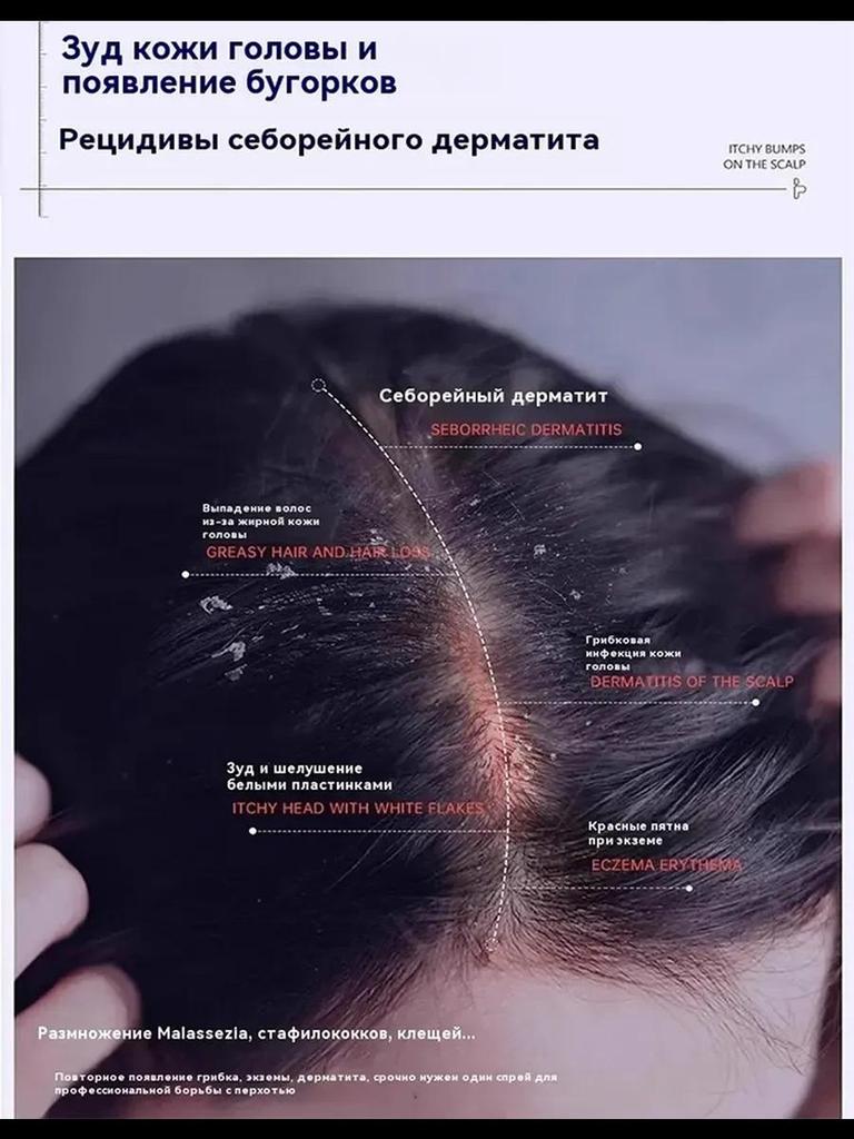 Ringworm Capitis and Scalp Special Spray Fungal Infection Dandruff Itching