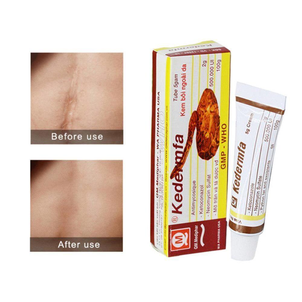 5g Vietnam Kedermfa 100% Original Snake Oil Hand Skin Face Care Cream Snake Balm Ointment Nourish