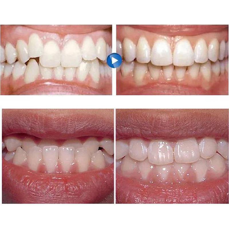 Dental Straightener Adult Fixed Silicone Braces Anti-Grinding Braces