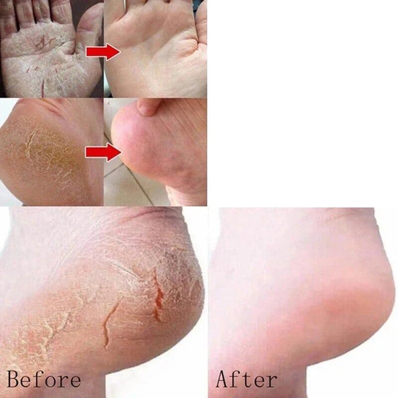 Foot Moisturizing Cream Is Rich In Plants and Can Be Used Flexibly for Dry, Cracked, and Rough Skin. Foot Moisturizing Cream