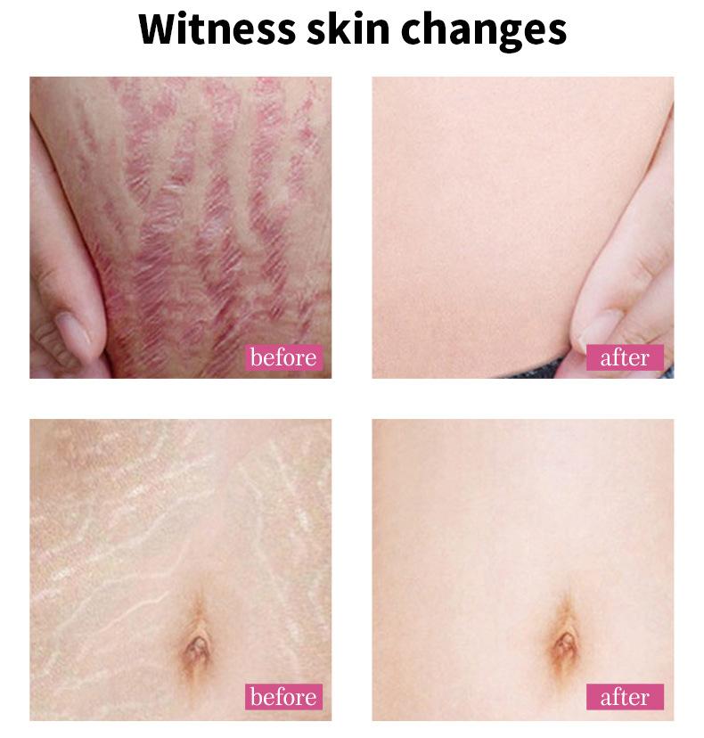 Крем для восстановления растяжек для беременных женщин. Послеродовое восстановление и исчезновение растяжек.