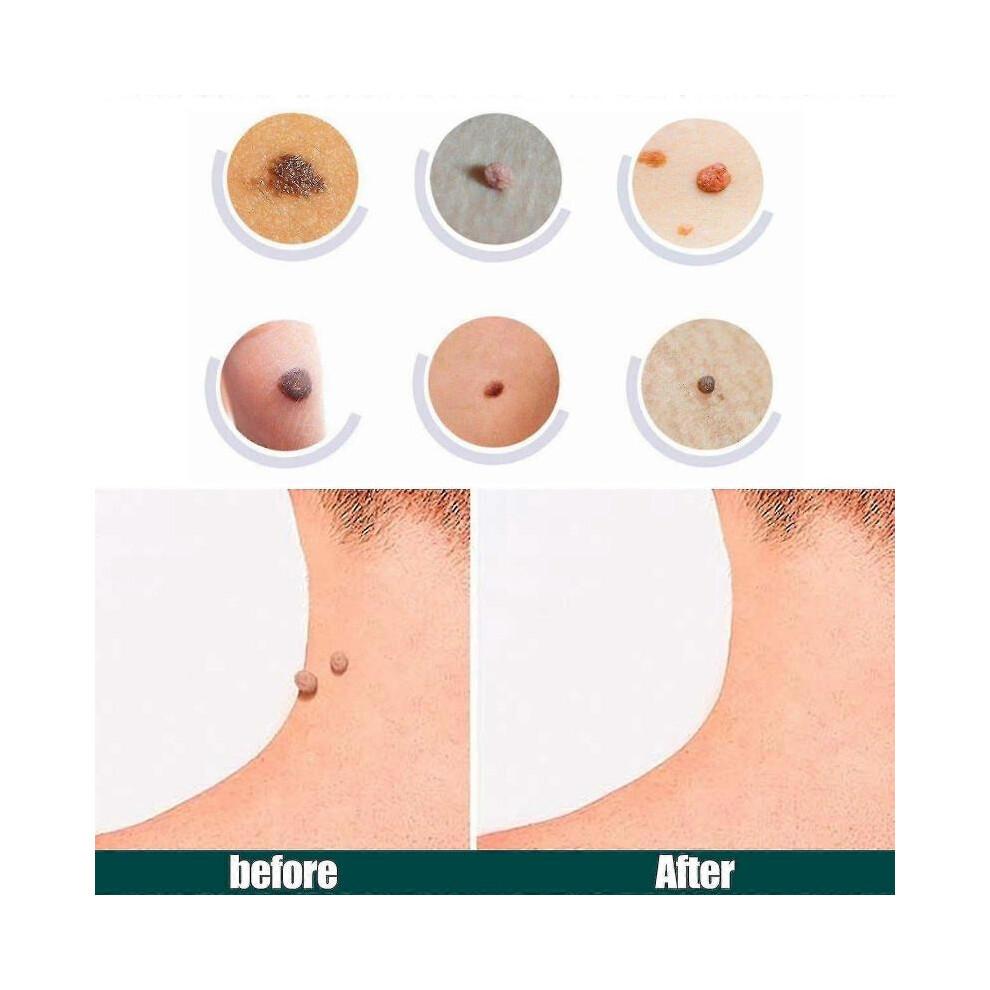 Natural Safe And Effective Ingredients Skin Tag Remover Patches And Improved Formulations Skin Tag Remover Patches