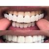 Стоматологический Snap Smile Стоматологические Верхние Накладные Зубы Cover Идеальная Улыбка Виниры Удобная Посадка Отбеливание Зубной Протез Брекеты Оборудование 2030