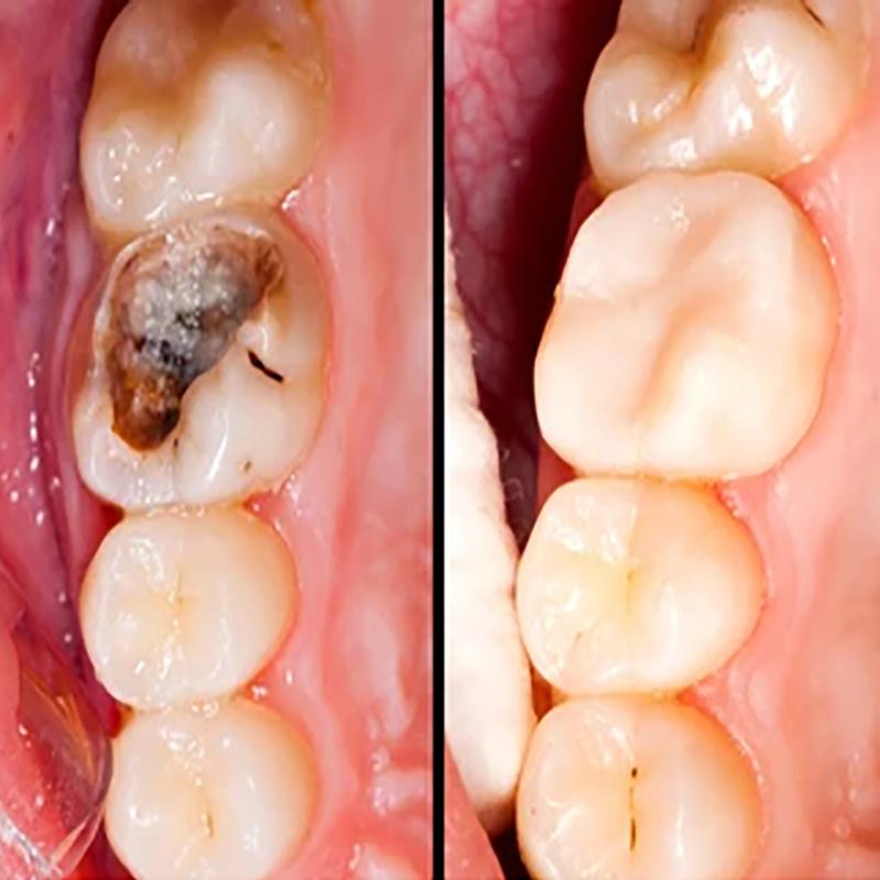 Капли для восстановления десен Быстрое лечение полостей Кариес Отбеливание зубов Удаление желтого налета Пятна Устранение кариеса Десен Зубная паста