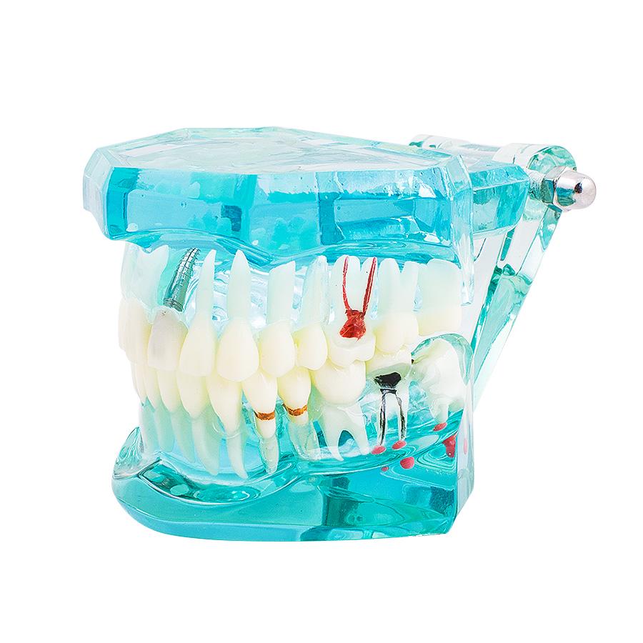 Dental Study Tooth Transparent Adult Pathological Teeth Model