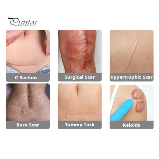 Силиконовые пластыри для рубцов, рулон ленты для рубцов, профессиональные мягкие полоски для рубцов после хирургических операций, келоидные рубцы, лечение угревой сыпи, силиконовый гелевый пластырь