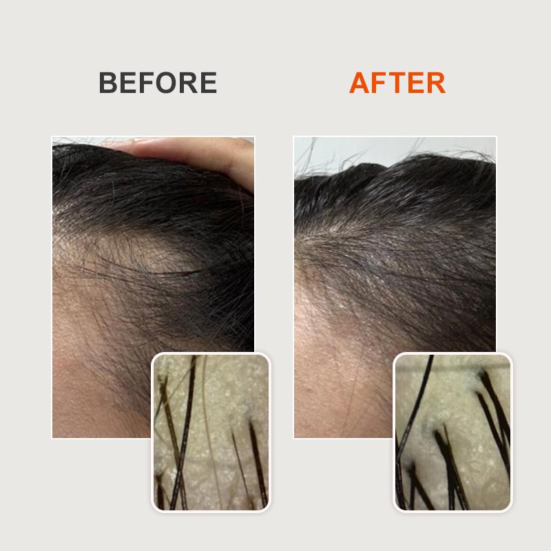 PURC Масло батана Спрей для роста волос Уход за волосами Против выпадения волос Быстрое восстановление роста Питательный спрей Масло розмарина Биотин Средства для роста волос