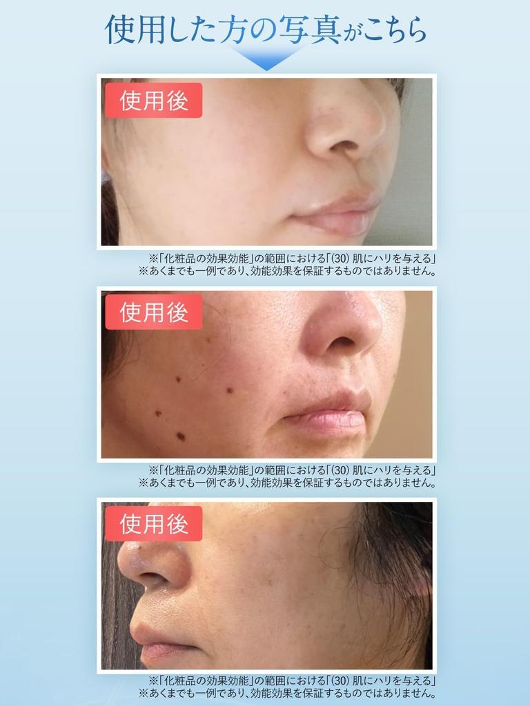 Nasolabial Kita No Kaiteki Kobo Hyaluronic Acid Needle Patch [For Folds] Refist, Patch,