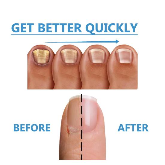 Экстра-сильное лечение грибка ногтей. Натуральный ремонт. Обновляющее средство с 7 маслами. Легкое нанесение. Здоровое средство для ногтей.