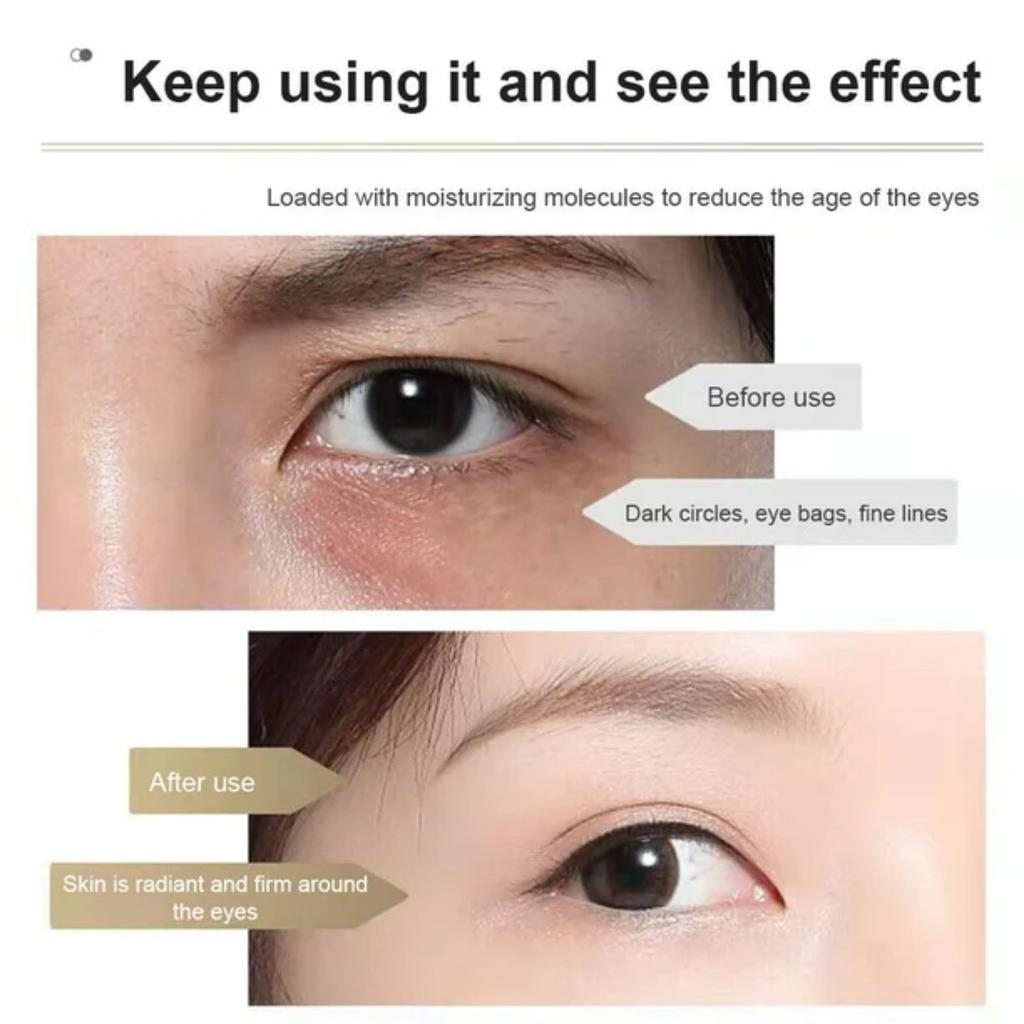 Гиалуроновые микроиглы для глаз, удаление морщин и тонких линий, 1 мл