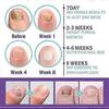 Medinail Fungus Spray,Toenail Fungus Treatment,Nail Fungus Treatment For Toenail