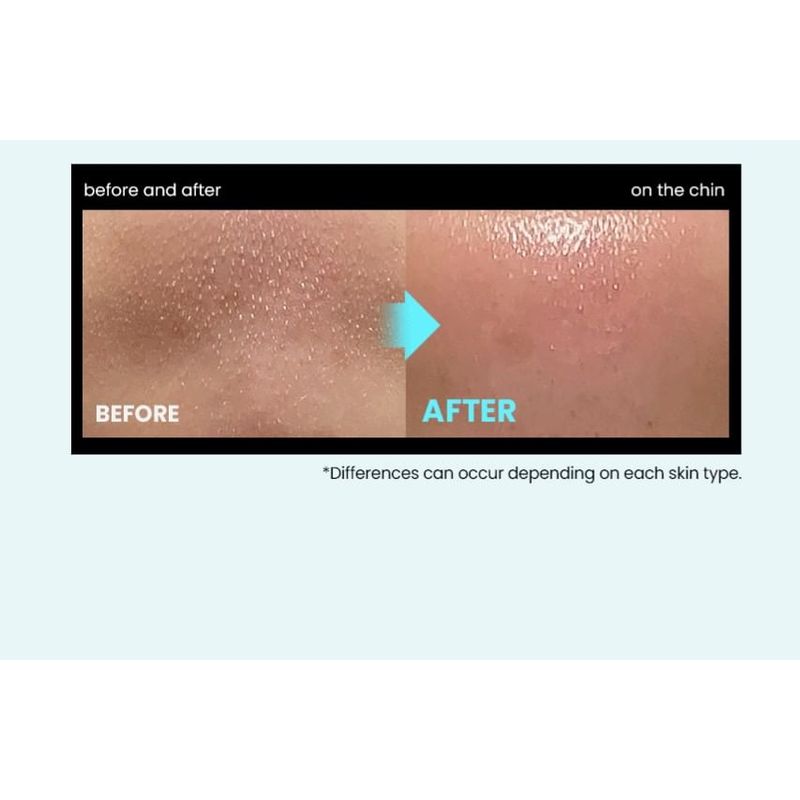 ilso Специальный набор Super Melting Sebum Softener