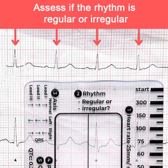 2/3 шт. ЭКГ линейка с 7 шагами пластиковый штангенциркуль для измерения электрокардиограммы измерительный инструмент прозрачное справочное руководство по интерпретации ЭКГ измерительная линейка